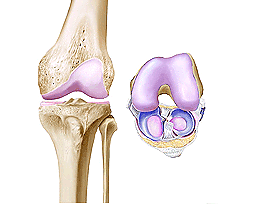 Osteoarthritis