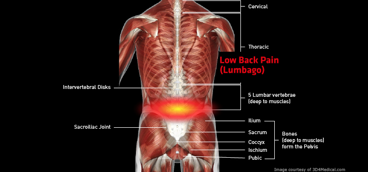 Low Back Pain