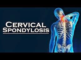 Cervical Spondylosis